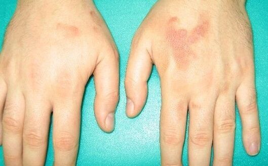 dor nas articulações das mãos podem ser sintomas de parasitas