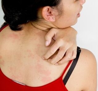 granulomas no corpo - sintomas da presença de parasitas