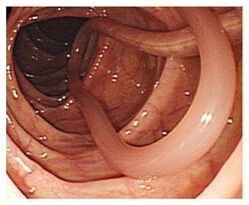 parasitas no corpo humano