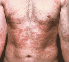 pele problemática é um sintoma da presença de parasitas