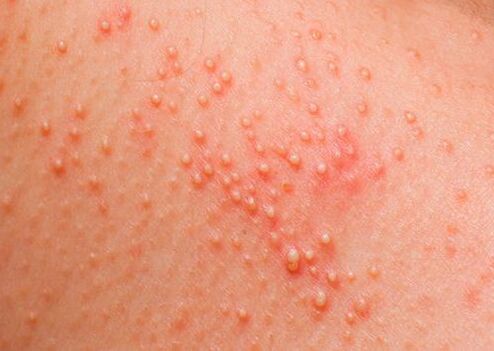 Se o corpo é afetado por parasitas, surge uma alergia na pele