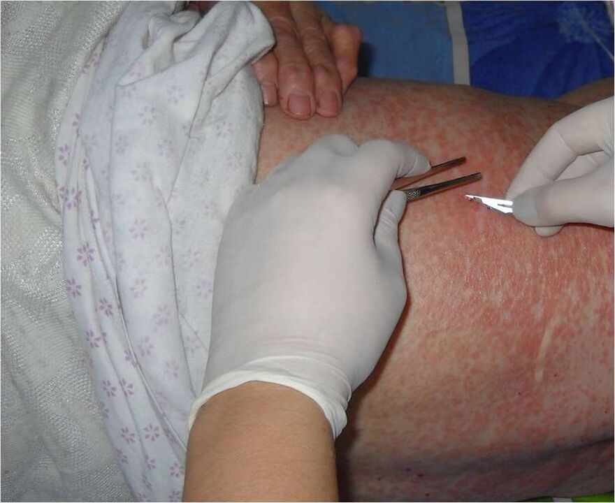 Raspagem da área afetada para detectar parasitas sob a pele