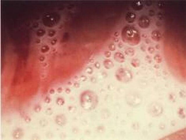 Descarga de bolhas com parasitas protozoários